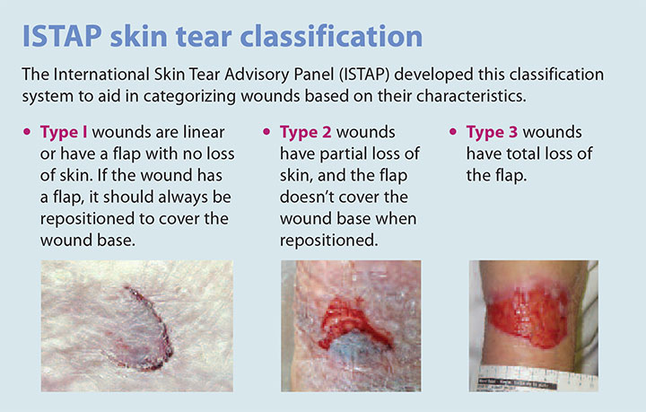tear assessment management prevention istap classification - American